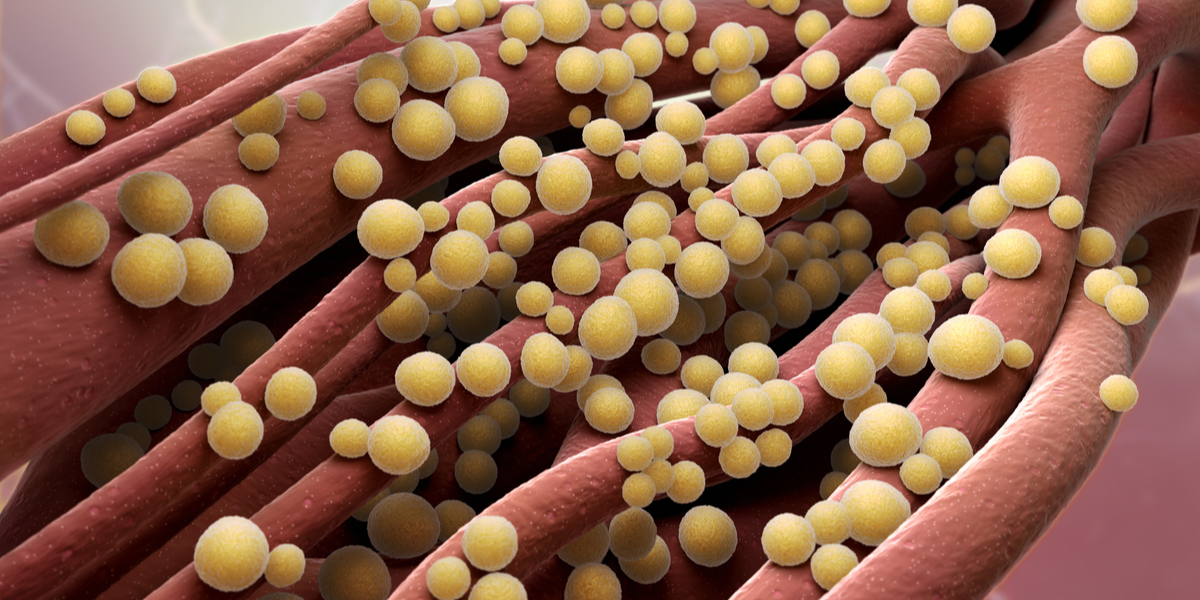 11 har fået blodforgiftning og tre er døde af antibiotikaresistente bakterier