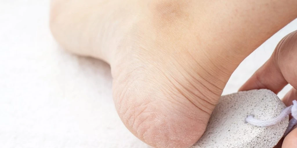 Alt for mange laver fejl, der gør det hele værre: Her er fodterapeutens metode til at slippe af med hård hud på fødderne