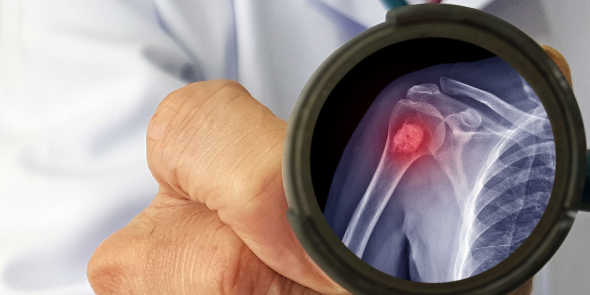 5 tidlige symptomer på knoglekræft, du skal kende