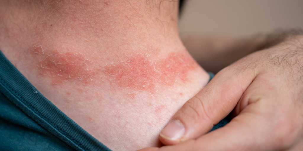 Enden på psoriasis? Forskere fra Københavns Universitet udvikler nyt plaster til behandling