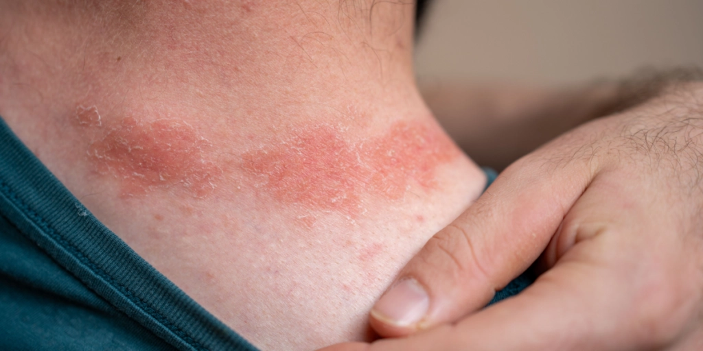 Enden på psoriasis? Forskere fra Københavns Universitet udvikler nyt plaster til behandling