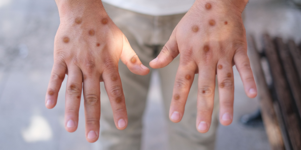 Forskere frygter øget spredning: mpox har muteret